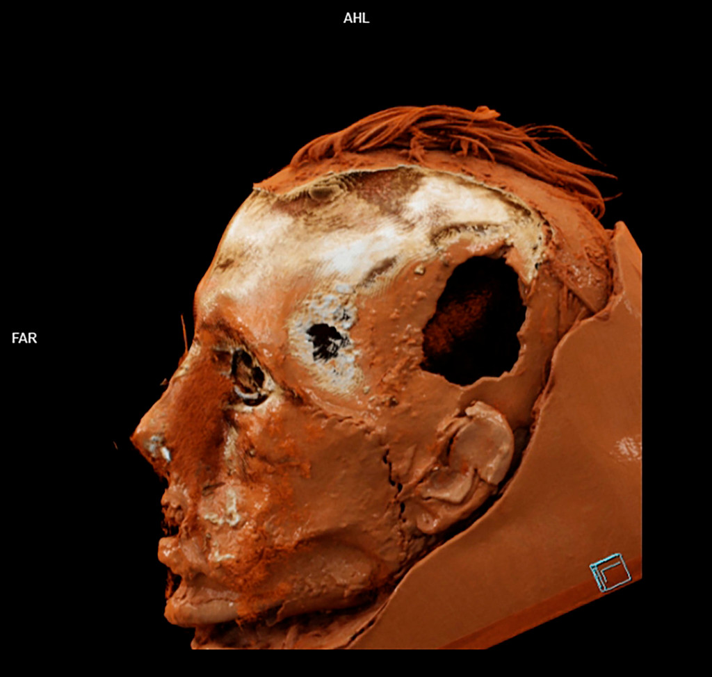 CT scan of the skin and skull with the scar and the trepanation hole visible