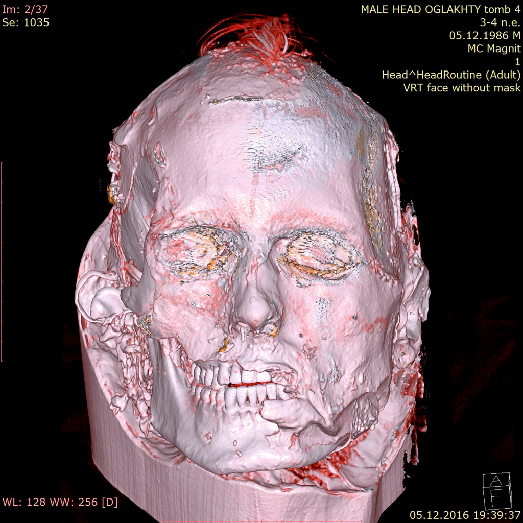 CT scan of the skin and skull